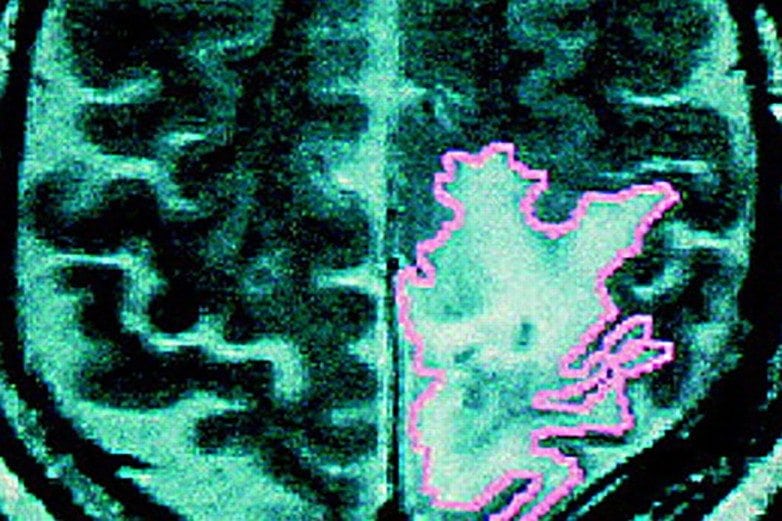 Marijuana can kill certain cancer cells and shrink some brain tumors