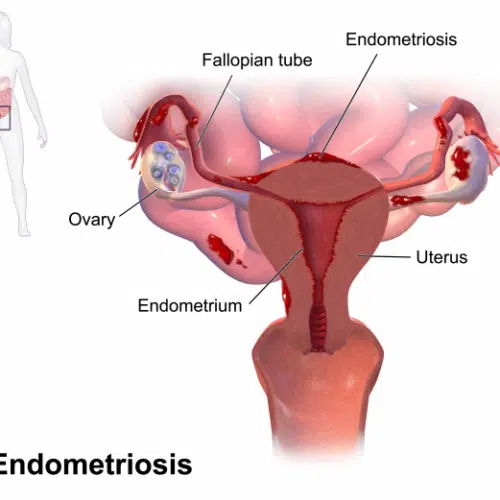 How Medical Marijuana Can Help Endometriosis
