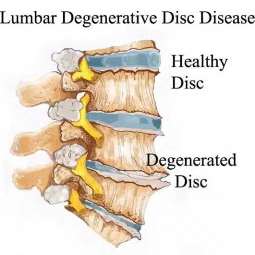 lumbar-degeneratiive-disc-disease